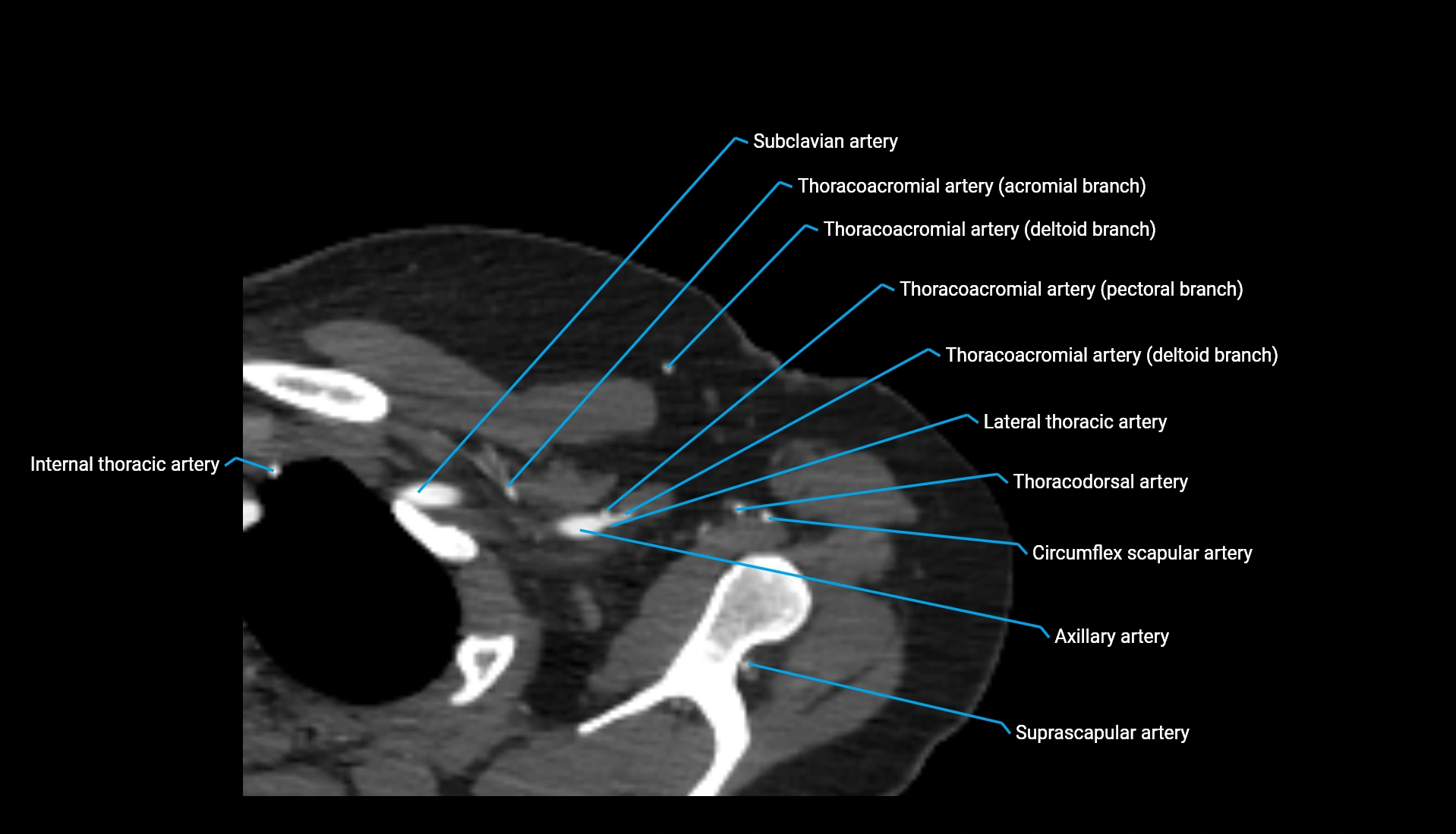 CTA upper limb axial cross sectional anatomy labelled image 336 (1).webp